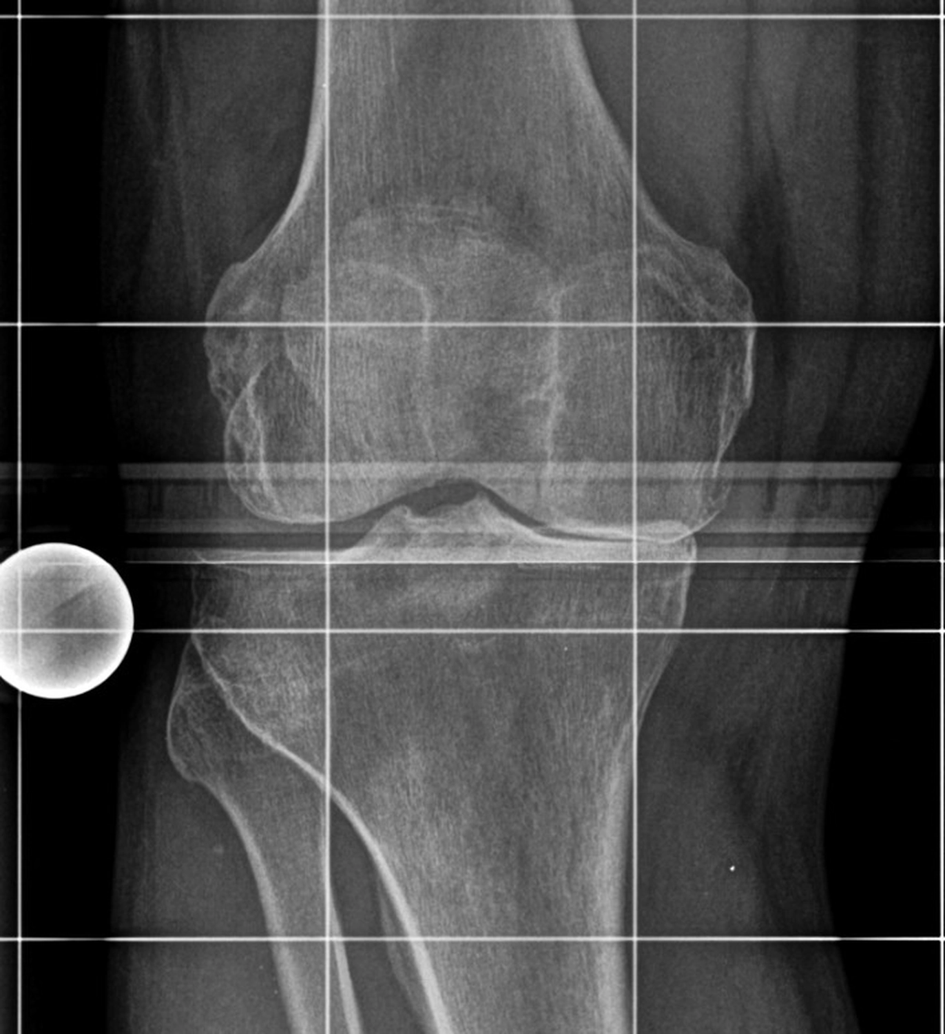 STENUM – Fachklinik für Orthopädie – Röntgenaufnahme des Knies mit Gelenkverschleiß 