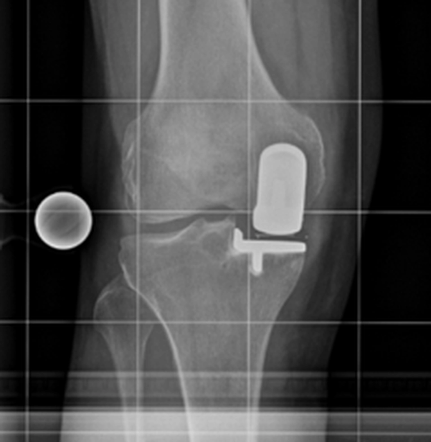 STENUM – Specialist Clinic for Orthopedics –  X-ray showing Partial prosthesis