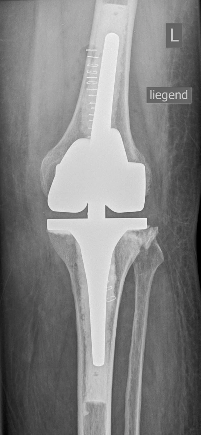STENUM – Fachklinik für Orthopädie –  Röntgenaufnahme mit Achsengeführt