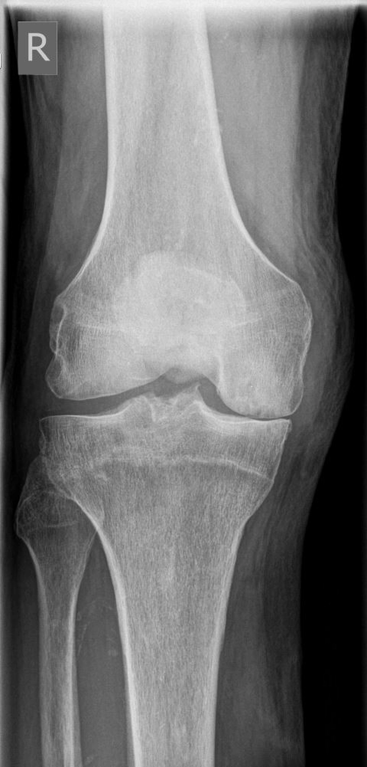 STENUM – Fachklinik für Orthopädie –  Röntgenaufnahme mit Teilprothese