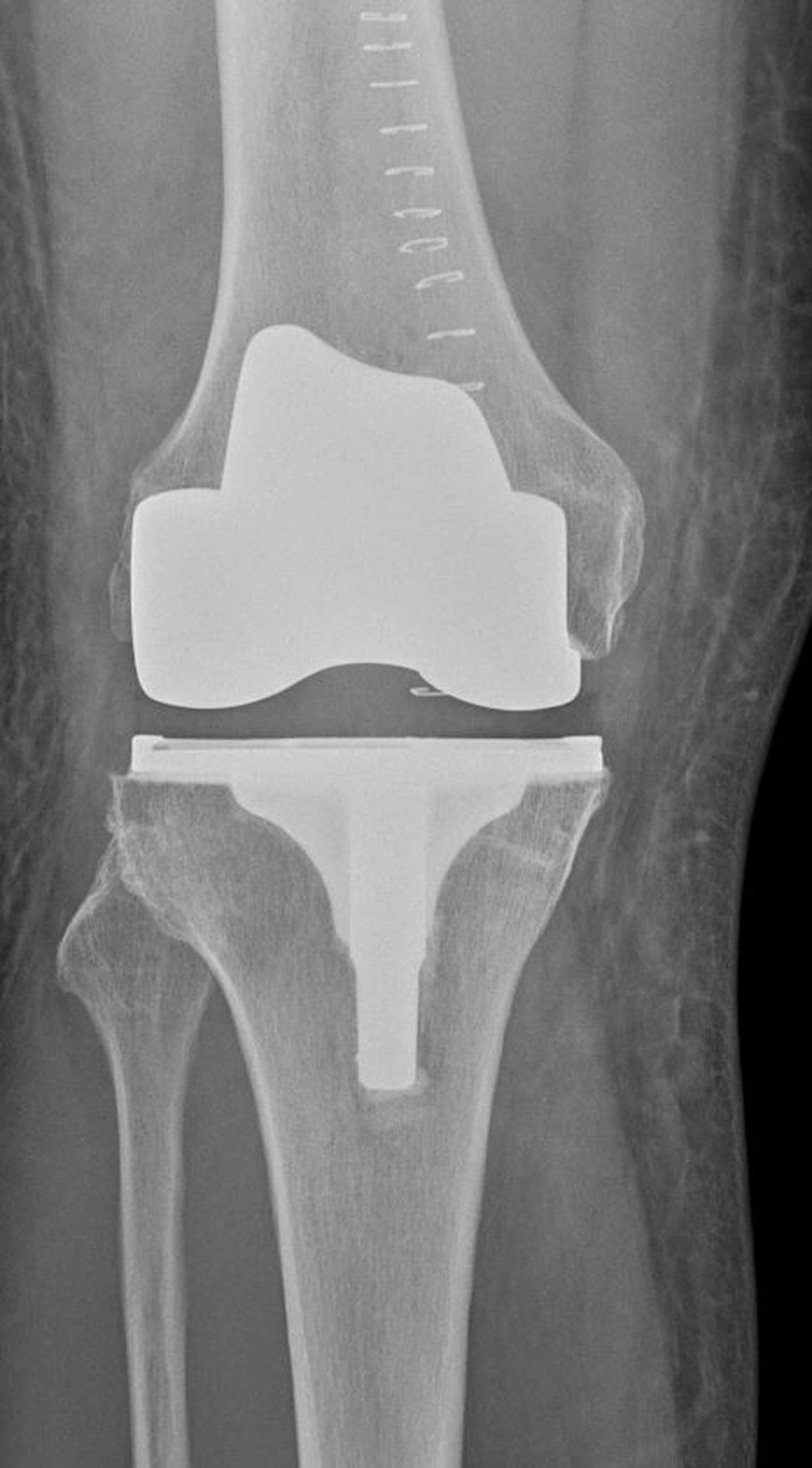 STENUM – Fachklinik für Orthopädie –  Röntgenaufnahme mit Totalendoprothese