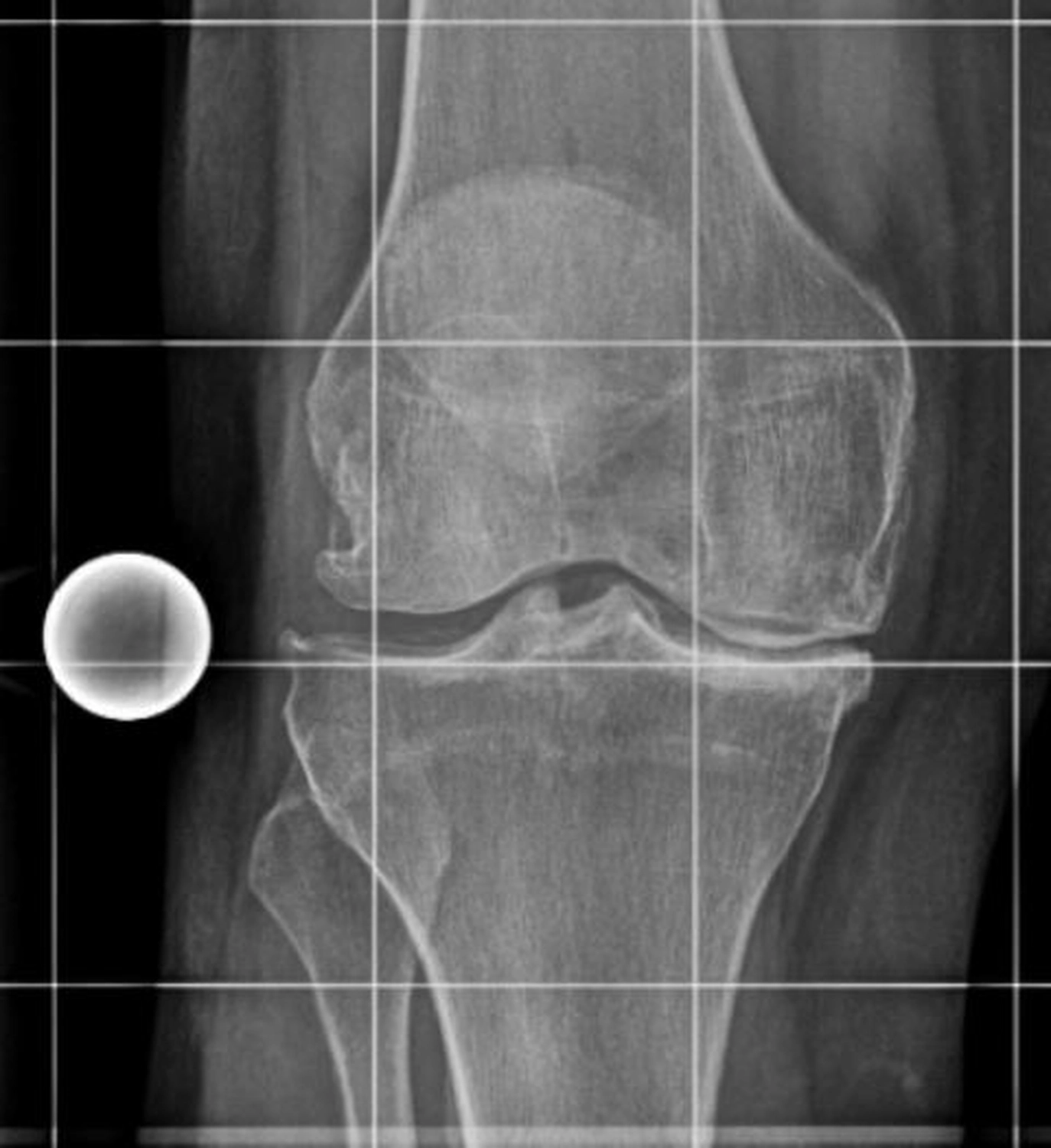 STENUM – Fachklinik für Orthopädie –  Röntgenaufnahme mit Totalendoprothese