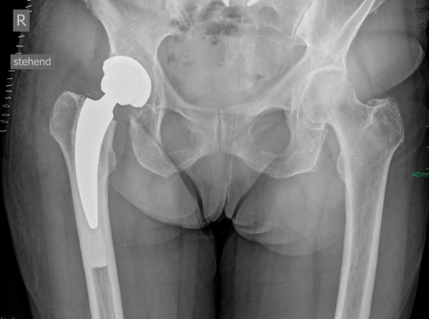STENUM – Fachklinik für Orthopädie –  Röntgenaufnahme der Hüfte mit Prothese auf der linken Seite