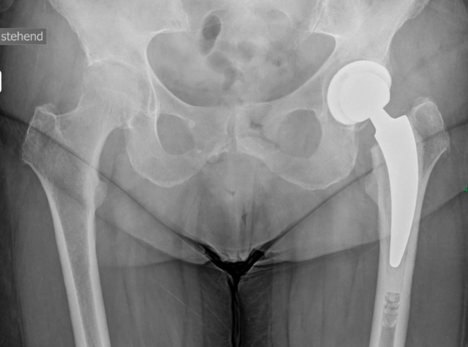 STENUM – Fachklinik für Orthopädie –  Röntgenaufnahme der Hüfte mit Prothese auf der rechten Seite